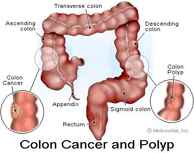 colon cancer.jpg